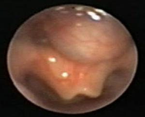 Fibrobroncoscopia: tumoración quística que tracciona epiglotis, deformándola e impidiendo el cierre completo de la glotis.
