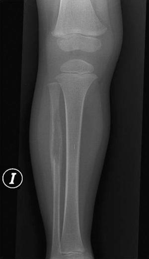 Radiografía AP de la pierna izquierda que muestra una lesión lítica, que rompe la cortical y con reacción perióstica, localizada en la diáfisis del peroné izquierdo.