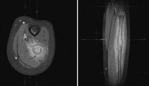 RM centrada en el tercio medio del peroné izquierdo (T2 fat-sat axial y coronal con gadolinio) que muestra una captación intensa por parte de la lesión, con patrón permeativo y rotura de la cortical ósea, junto a extensión hacia las partes blandas adyacentes.