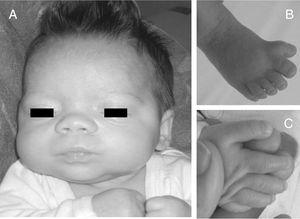 Paciente. A) Aspecto facial. B) Polidactilia preaxial en ambos pies. C) Primer dedo grande y ancho.
