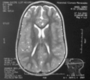 Imagen de resonancia magnética que muestra la atrofia de corteza frontal con ampliación del espacio subaracnoideo.