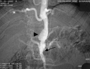 Doppler renal hta