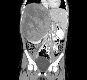 Resonancia magnética tras inyección de gadolinio, corte coronal. Se observa cómo el tumor desplaza hígado, aorta y vena cava inferior.