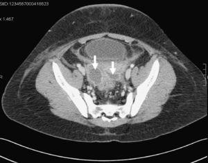 Tomografía computarizada pélvica. Absceso multiloculado dependiente del ovario derecho.