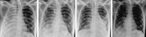 Evolución radiológica del paciente del caso 1 con fisioterapia respiratoria y asistencia mecánica de la tos. Imagen 1, 20/09/2009 (16:00h). Imagen 2, 21/09/2009 (6:00h). Imagen 3, 21/09/2009 (16:00h). Imagen 4, 23/09/2009 (11:00h).