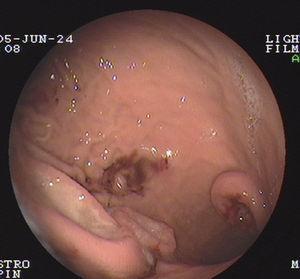 Endoscopia digestiva. Presencia a nivel gástrico de 3 tumoraciones con cráter central, ulcerado, rodeadas de mucosa macroscópicamente normal.