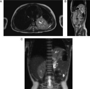 RM axial (A), sagital (B) y coronal (C) en T2. Hernia diafragmática posterior izquierda con riñón izquierdo y contenido intestinal.