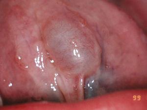 Mucocele oral congénito en la cara ventral de la lengua.