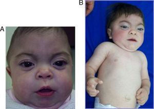 Paciente de 5 meses de edad (A) y 27 meses (B): facies toscas, párpados esponjosos, córneas claras, limitación a la extensión articular y hernia umbilical.
