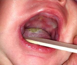 Aspecto de la lengua del paciente después de una semana de tratamiento.