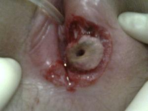 Imagen de la lesión ulcerosa a nivel vulvar.