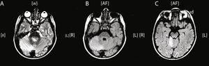 RM craneal axial. A) Imagen T2 con hiperintensidad en cortex de hemisferio cerebeloso derecho. B) Secuencia FLAIR con hiperintensidad hemisferio cerebeloso derecho. C) Secuencia FLAIR con afectación vermis cerebeloso.