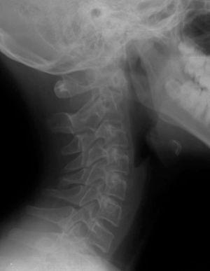 Radiografía lateral de la columna vertebral cervical.