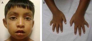 A) Se observan las cejas arqueadas y con el tercio externo disperso. Puente nasal deprimido. Fisuras palpebrales largas, con eversión del párpado inferior. B) Se observan la braquidactilia y la clinodactilia del quinto dedo de ambas manos.