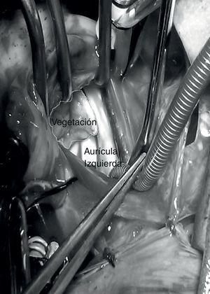 Vista intraoperatoria de la aurícula izquierda. Se observa la gran vegetación que sustituyó completamente el tejido valvular mitral, creando severa obstrucción.