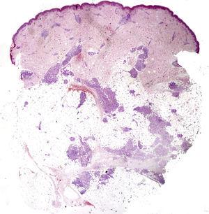 Imagen panorámica en la que se observan múltiples granulomas ocupando la zona periseptal de los lobulillos adiposos (20×HE).