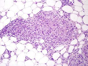 Gran aumento de uno de los granulomas sarcoideos paraseptales. Están constituidos por células epitelioides sin corona linfocitaria ni necrosis septal (250×HE).