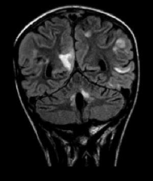 RM craneal, secuencia FLAIR con corte coronal. Se observan cambios posquirúrgicos en la fosa posterior. Hay múltiples zonas en sustancia blanca hiperintensas, localizadas a nivel subcortical en áreas parieto-occipitales, de forma bilateral.