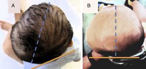 Representación artística de una (A) plagiocefalia y una (B) braquicefalia posicional.