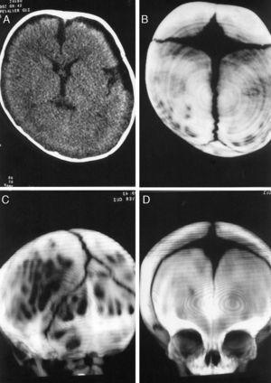 A) TC craneal de un niño con plagiocefalia occipital derecha que muestra colecciones pericerebrales de LCR. B-D) TC-3D del mismo paciente que confirma la permeabilidad de todas las suturas descartando que se trate de una craneosinostosis.
