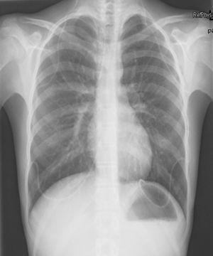 Radiografía de tórax donde se objetivan las dos derivaciones ventrículo-pleurales insertadas en la paciente del primer caso tras la curación de la infección.