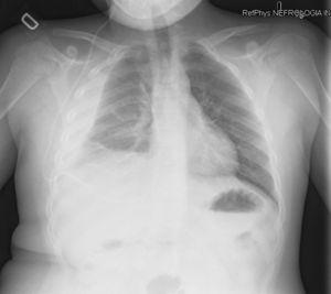 Radiografía de tórax donde se muestran la condensación lobar y el derrame paraneumónico en el paciente de nuestro segundo caso, portador de un drenaje ventrículo-pleural.