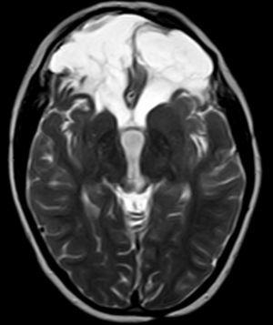 RM cerebral a las 2 semanas del traumatismo: en secuencia T2, corte coronal, se observan extensas cavidades encefalomalácicas macroquísticas en circunvoluciones anterobasales frontales bilaterales.