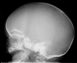 Radiografía de perfil de cráneo del paciente 1 mostrando craneosinostosis de la sutura sagital y dolicocefalia.