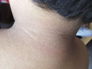 Región posterior del cuello del paciente 2 mostrando acantosis nigricans.