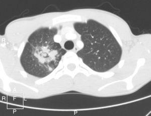 Tomografía computarizada que muestra una dilatación del bronquio segmentario apical del lóbulo superior derecho, con contenido hipodenso en su interior (compatible con broncocele).