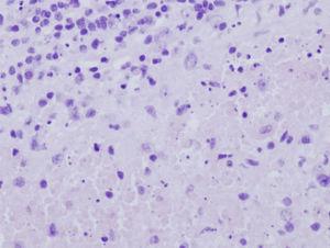 Enfermedad de Kikuchi-Fujimoto. Áreas de necrosis no neutrofílica con intensa cariorrexis sin que se observen eosinófilos o células plasmáticas en número significativo.