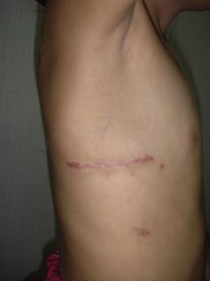 Cicatriz axilar 2 meses después de la intervención.