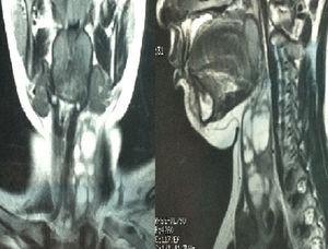 RMN cervical al diagnóstico. Proyecciones lateral y anteroposterior.
