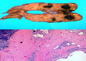 Superior: sspecto macroscópico de la pieza quirúrgica de timo aberrante. Inferior: H&E×40. Granuloma con cristales de colesterol (arriba centro), quiste revestido por epitelio benigno (abajo derecha) y tejido tímico normal (arriba izquierda), separados por estroma fibroso con focos inflamatorios.