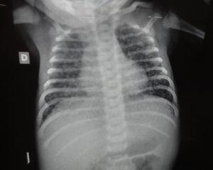 Radiografía de tórax: patrón retículo-nodulillar bilateral.