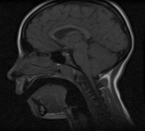 Resonancia magnética en la que se observa el descenso de las amígdalas cerebelosas.
