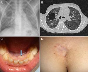 A y B) Neumatocele en el lóbulo superior derecho. C) Retraso en la caída de dentición caduca, con erupción de segunda dentición (dientes de tiburón). D) Fosita y angioma en la región sacra.