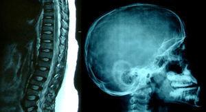 Imagen por RMN de la columna lumbar que muestra las deformaciones bicóncavas en los cuerpos vertebrales y radiografía de cráneo con imagen en «sal y pimienta».