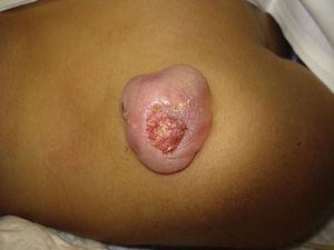 Lesión tumoral de gran tamaño, de consistencia dura y con una zona central ulcerada.