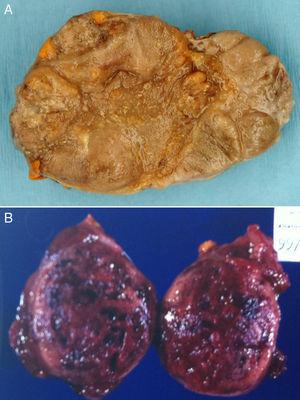 Aspecto macroscópico de un tumor corticosuprarrenal (A) y de un feocromocitoma (B).