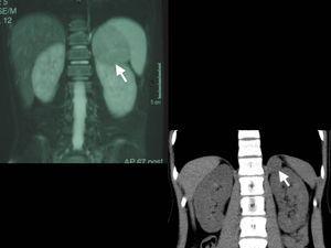 Imágenes de tomografía axial computarizada de 2 tumores corticosuprarrenales (flechas).