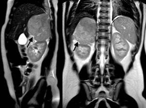 Imagen de resonancia magnética de un tumor corticosuprarrenal derecho de gran tamaño (flechas).