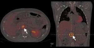 Imagen de tomografía por emisión de positrones de un resto de tumor corticosuprarrenal (flechas) tras la resección de la masa.