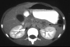 Imagen de feocromocitoma obtenida mediante tomografía axial computarizada (flecha).
