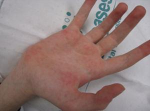 Reacción cutánea al tratamiento con sorafenib en la mano de la paciente. Véase también la longitud de los dedos de las manos y la separación entre el primer metacarpiano y el resto.