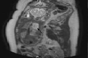 Imagen de resonancia magnética prenatal.