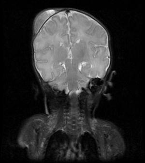 RM craneal en corte coronal donde se aprecia el cefalohematoma parietal derecho pero sin presencia de lesión intracraneal asociada.