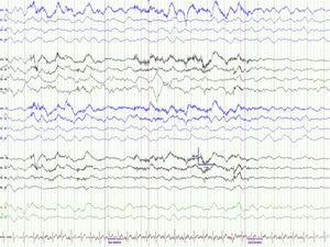 EEG en el momento agudo (día 1 del cuadro) que muestra enlentecimiento generalizado.
