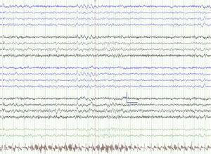 EEG en el momento intercrítico (día 22 del cuadro) que muestra enlentecimiento localizado en hemisferio izquierdo.