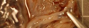 Visión macroscópica de la placenta en la que se observa la inserción velamentosa del cordón umbilical.